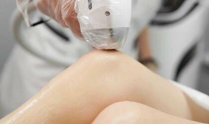 Лазерная эпиляция