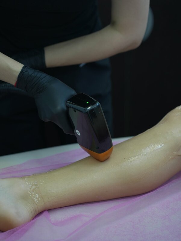 lazernaja-epiljacija-2