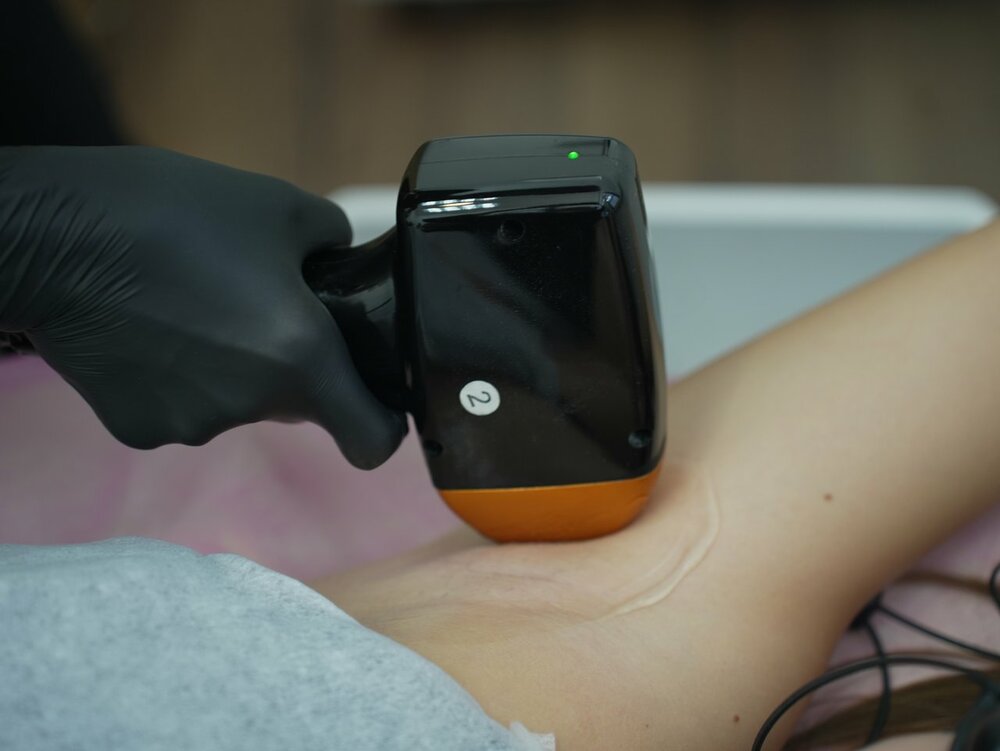 lazernaja-epiljacija-9